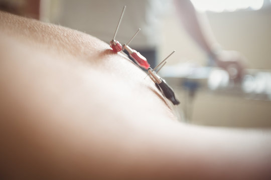 Close-up of patient getting electro dry needling on his shoulder