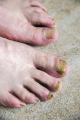 onychomycosis with fungal nail infection two feet