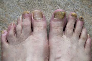 onychomycosis with fungal nail infection two feet