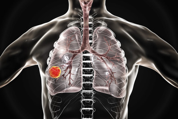 Lung cancer, medical concept, 3D illustration showing cancerous tumor inside human lung