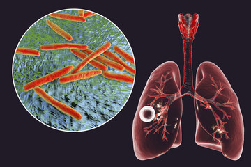 Fibrous-cavernous pulmonary tuberculosis and close-up view of Mycobacterium tuberculosis bacteria, 3D illustration showing cavity in the lung