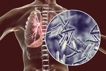 Secondary tuberculosis in lungs and close-up view of Mycobacterium tuberculosis bacteria, 3D...