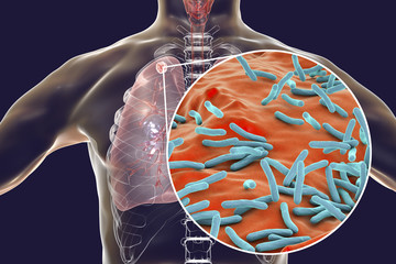 Secondary tuberculosis in lungs and close-up view of Mycobacterium tuberculosis bacteria, 3D...