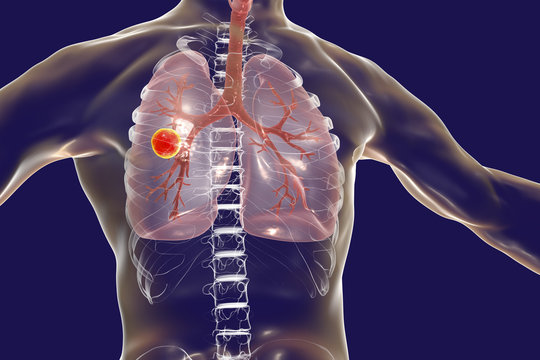 Fibrous-cavernous pulmonary tuberculosis, 3D illustration showing tuberculosis cavity in the lung