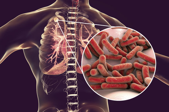 Secondary tuberculosis in lungs and close-up view of Mycobacterium tuberculosis bacteria, 3D illustration