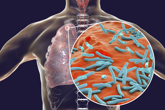 Secondary tuberculosis in lungs and close-up view of Mycobacterium tuberculosis bacteria, 3D illustration