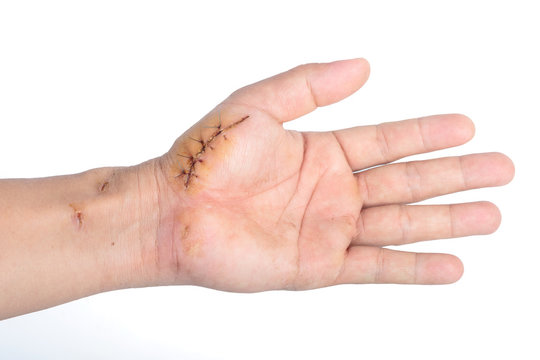 suture wound on hand isolate on white