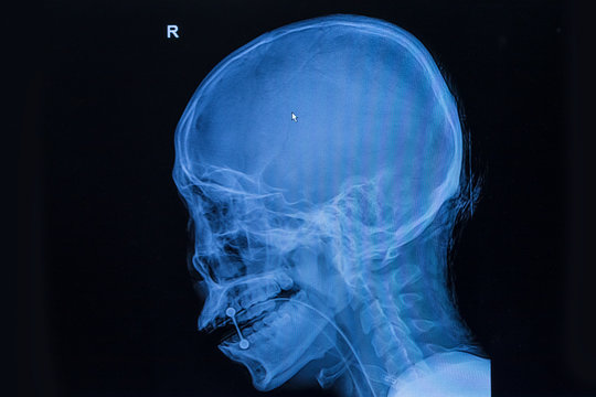 film x-ray skull and cervical spine lateral view