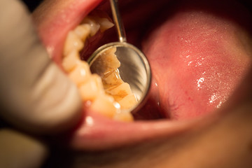 A dentist makes teeth to a woman