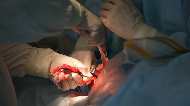 A striking closeup of orthopedic surgeons inserting big instruments in a red wound while fixing a coxal joint in an operation room