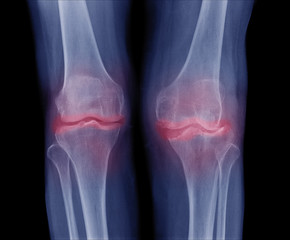 x-ray image of both knee Osteoarthritis (OA Knee), show narrow joint space ( joint cartilage loss ) , osteophyte , subchondral sclerosis, Radiography with deformed knee joint