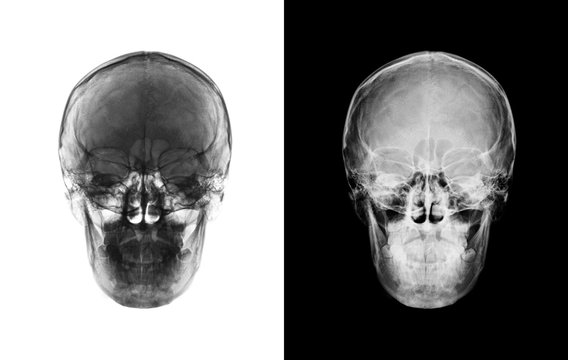 X-ray image of front view asian skull black and white