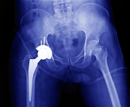 immediate postoperative x-ray image of both hip, anteroposterior view. Showing total Hip joint Replacement and hip prosthesis on right side.