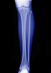 x-ray image of leg front view , xray of normal leg bone in adult