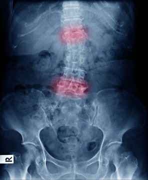 X-ray image front view of lumbar spines show deformity and compression fracture at red area mark and Scoliosis , ankylosing spondylitis