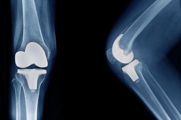 x-ray show knee joint replacement / knee arthroplasty front view and side view