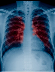 View of a adult x-ray film, taken to examine the lungs for a medical diagnosis red color show secretion or cancer in lungs