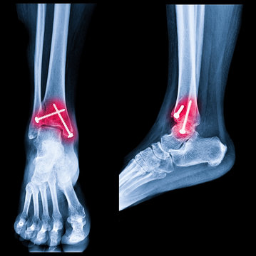 X-ray image of ankle fracture , broken ankle , pott fracture fix by open surgery and metal screw