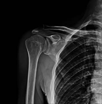 X-ray film of normal shoulder joint pain.