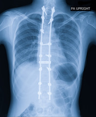 X-ray image of adult patient spine show Scoliosis surgery fix by long metal rod and many screw for spinal bend in adult people. Adult scoliosis fix Medical concept.