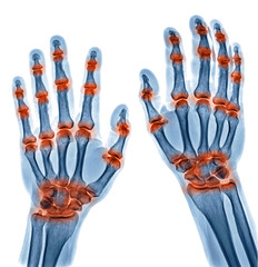 x ray image of multible joint inflammation in both hands caused by Gout arthritis, Rheumatoid...