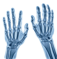 Normal male Hand x-ray both side isolated on white background process in blue tone