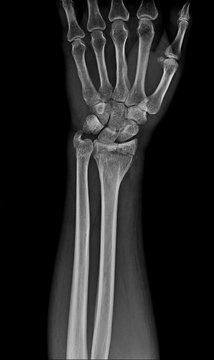 wrist x ray / x-ray show Distal Radius Fractures (Broken Wrist)