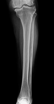 Lower leg xray , x-ray image of leg front view , xray of normal leg bone in adult