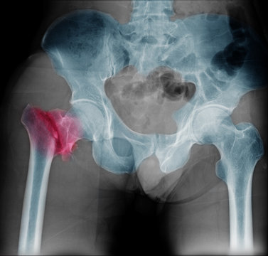 Hip fracture xray photo image. X-ray of hip joint for elderly patient who falling in the house. Bone process to blue tone and fracture area marked in red color.