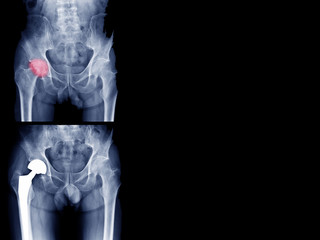 total hip replacement, osteoarthritis of hip joint , artificial hip joint, hip pain