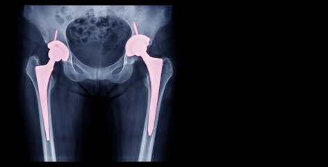 total hip replacement, osteoarthritis of hip joint , artificial hip joint, hip pain