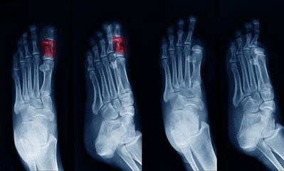 X-ray image of foot , can see fracture at Big toe at red area mark and show Big toe amputated