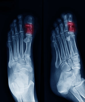 X-ray image of foot , can see fracture at Big toe at red area mark