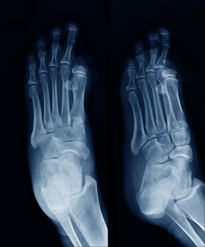X-ray image of foot , show Big toe amputated