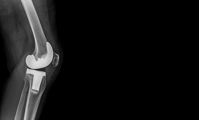 x-ray image of total knee arthroplasty / total knee replacement side view show metallic joint implant in bone