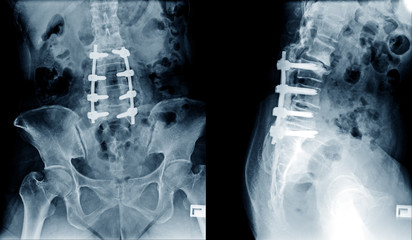 X-ray image of lumbar spine postoperative treatment for degenerative lumbar disc disease by decompression and fix by iron rod and screws - obrazy, fototapety, plakaty