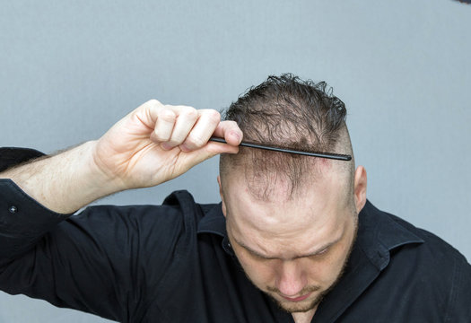 depressed man with hair loss using a comb 