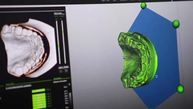 Creation on the computer model of the future prosthesis of teeth