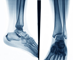 Ankle X-ray front side and left side on white background for treatment.