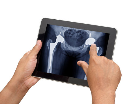 Doctor checking x ray of patient who have both side total hip replacement in tablet by use hospital application.