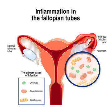 Inflammation in the fallopian tubes and primary cause of infection