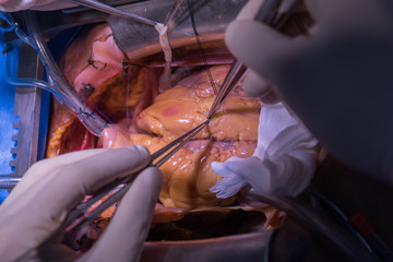 Doctors team wear blue coat perform heart surgery at the operating room in the hospital.