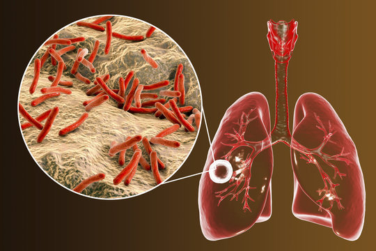 Fibrous-cavernous pulmonary tuberculosis and close-up view of Mycobacterium tuberculosis bacteria, 3D illustration showing cavity in the lung