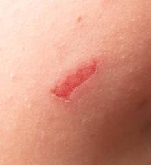 Fototapeta premium A wound on the human skin as a background