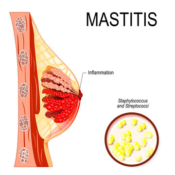 Mastitis. inflammation of the breast (abscess formation).