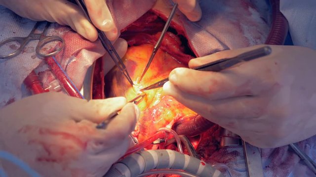 Close up of a human heart getting a microcut during an open surgery