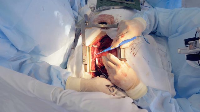 Vascular procedure is being carried out on a patient with cut-open chest