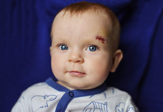 Baby With Scar On The Face