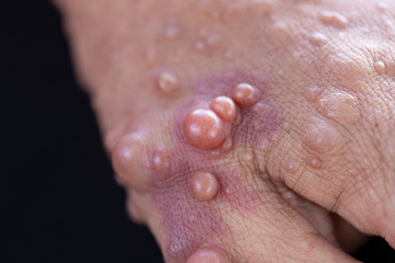 Neurofibromatosis (NF) is conditions in which tumors grow, symptoms include light brown spots on...