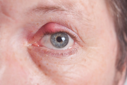 Painfully red eye sty, infected purulent eye